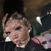 vitiligobarbie_